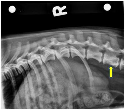 Frontiers | case report: corpectomy and iliac crest bone autograft as